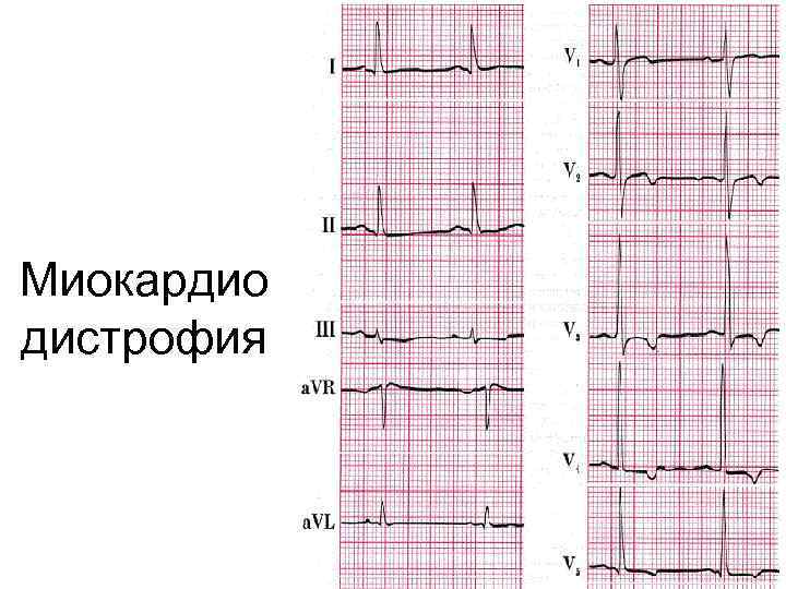 Миокардио дистрофия 