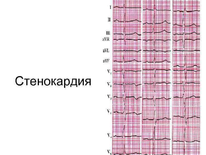 Стенокардия 