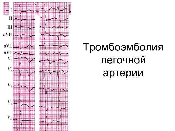 Тромбоэмболия легочной артерии 