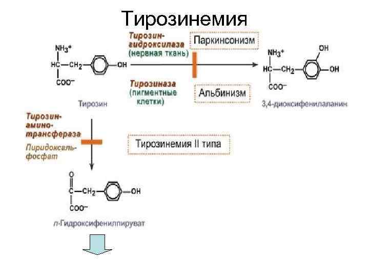 Тирозинемия 