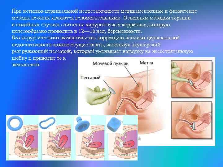 При истмико-цервикальной недостаточности медикаментозные и физические методы лечения являются вспомогательными. Основным методом терапии в