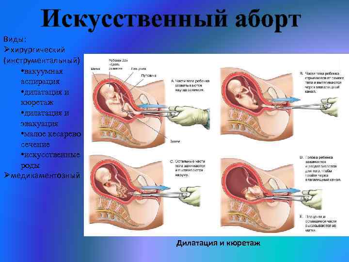 Искусственный аборт Виды: Øхирургический (инструментальный) • вакуумная аспирация • дилатация и кюретаж • дилатация