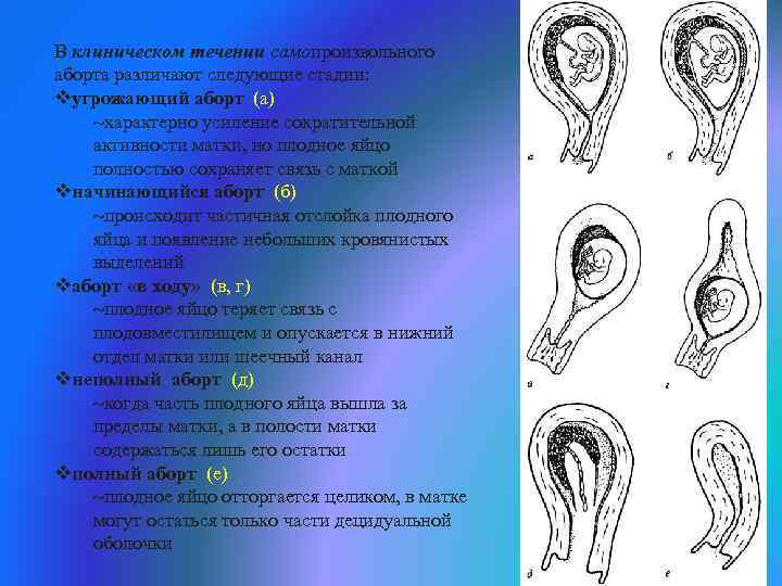 В клиническом течении самопроизвольного аборта различают следующие стадии: vугрожающий аборт (а) характерно усиление сократительной