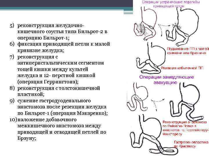 5) реконструкция желудочнокишечного соустья типа Бильрот-2 в операцию Бильрот-1; 6) фиксация приводящей петли к
