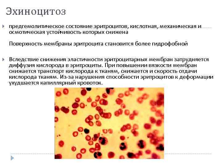 Эхиноцитоз предгемолитическое состояние эритроцитов, кислотная, механическая и осмотическая устойчивость которых снижена Поверхность мембраны эритроцита