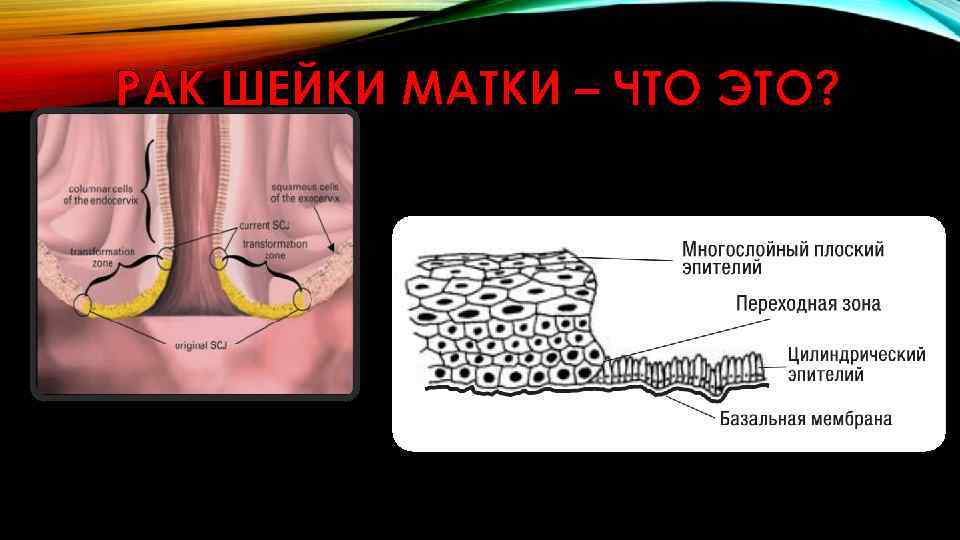 РАК ШЕЙКИ МАТКИ – ЧТО ЭТО? 
