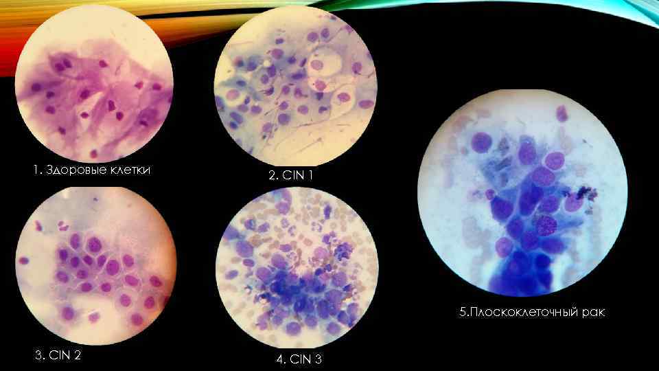 1. Здоровые клетки 2. CIN 1 5. Плоскоклеточный рак 3. CIN 2 4. CIN