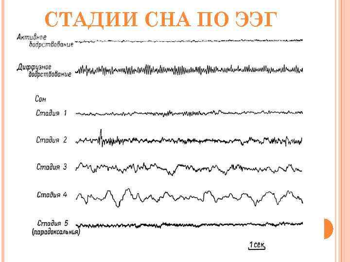 СТАДИИ СНА ПО ЭЭГ 