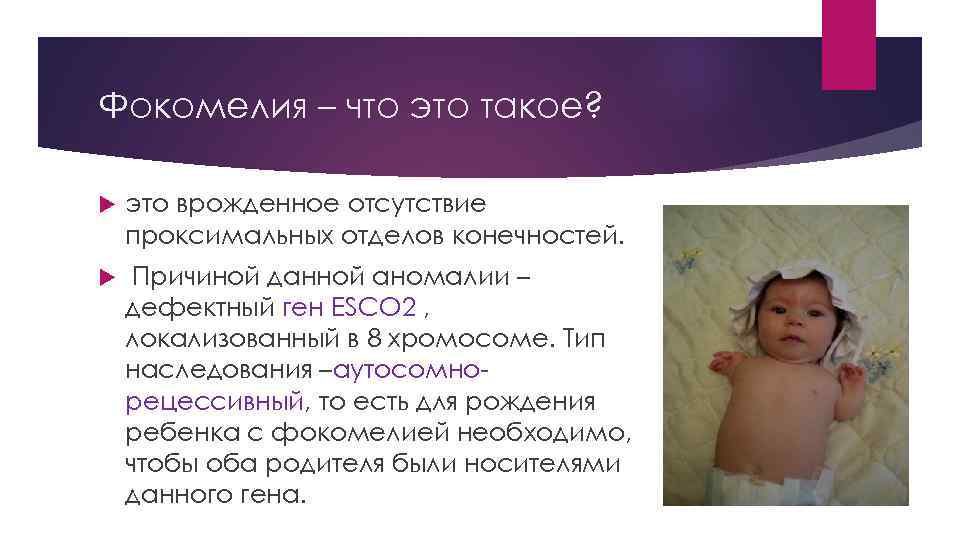 Фокомелия – что это такое? это врожденное отсутствие проксимальных отделов конечностей. Причиной данной аномалии