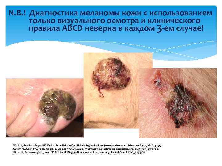 N. B. ! Диагностика меланомы кожи с использованием только визуального осмотра и клинического правила