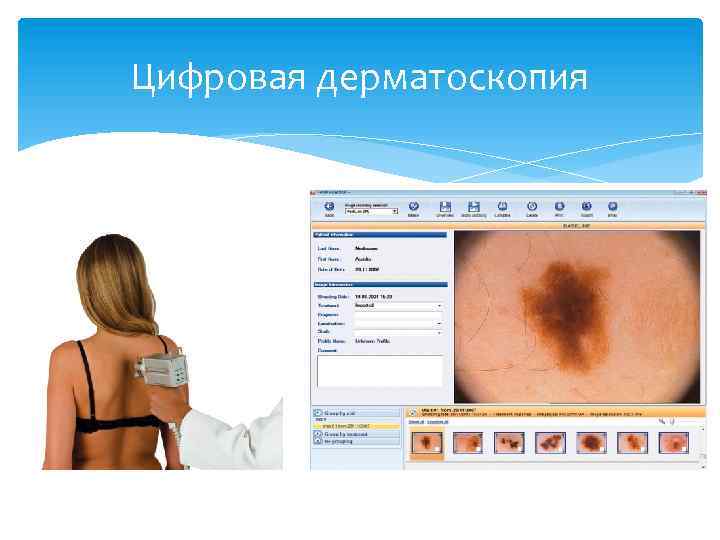 Цифровая дерматоскопия 