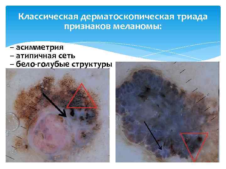 Классическая дерматоскопическая триада признаков меланомы: – асимметрия – атипичная сеть – бело-голубые структуры 
