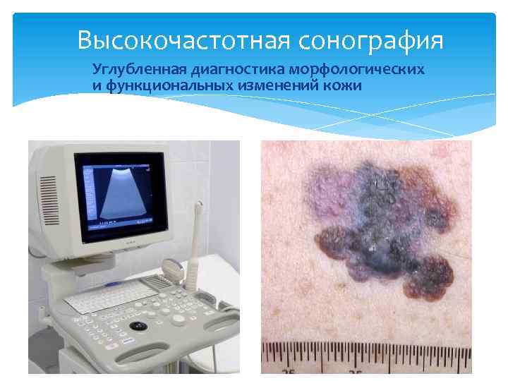 Высокочастотная сонография Углубленная диагностика морфологических и функциональных изменений кожи 