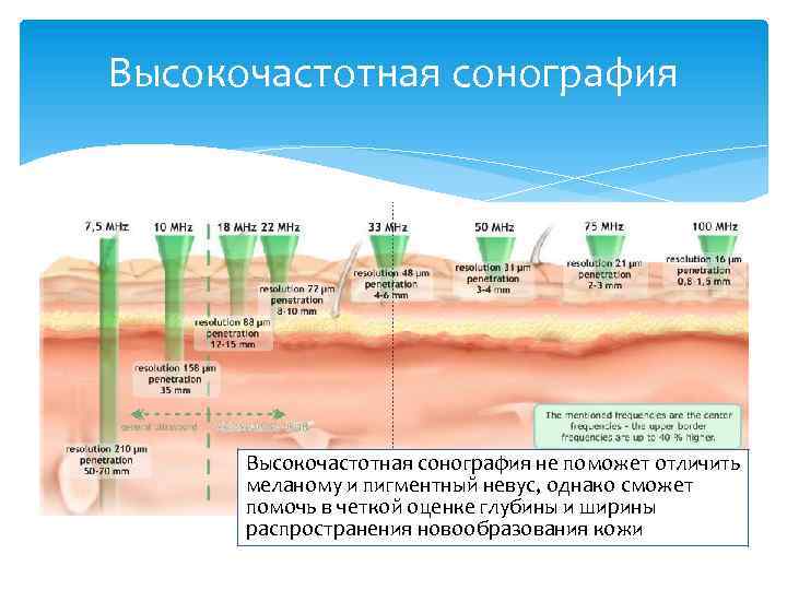 Высокочастотная сонография не поможет отличить меланому и пигментный невус, однако сможет помочь в четкой