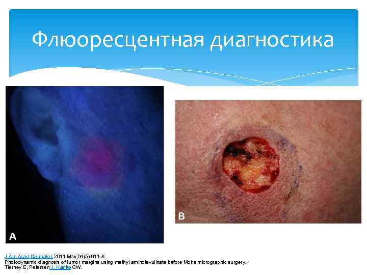 Флюоресцентная диагностика J Am Acad Dermatol. 2011 May; 64(5): 911 -8. Photodynamic diagnosis of