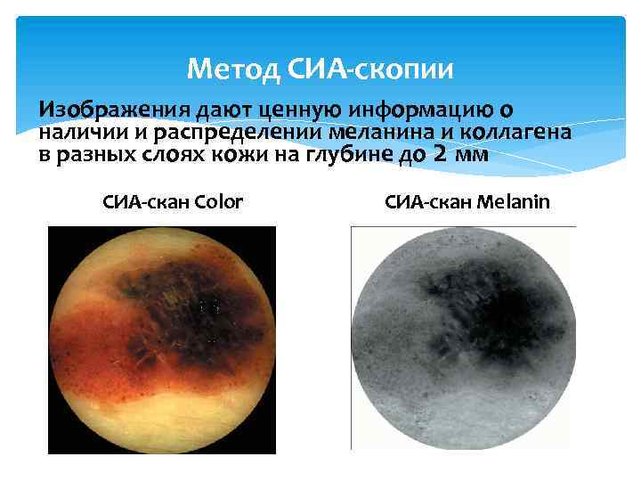 Метод СИА-скопии Изображения дают ценную информацию о наличии и распределении меланина и коллагена в
