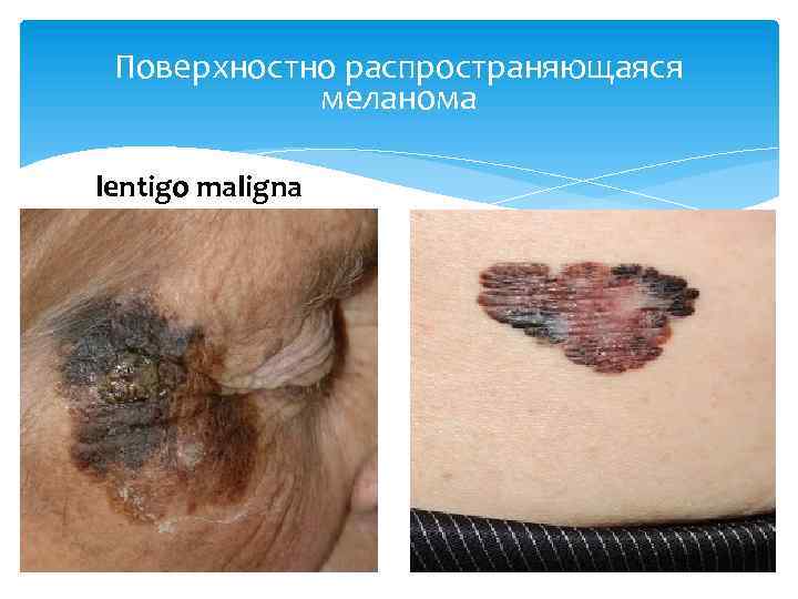 Поверхностно распространяющаяся меланома lentigo maligna 