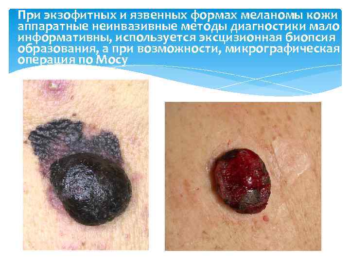 При экзофитных и язвенных формах меланомы кожи аппаратные неинвазивные методы диагностики мало информативны, используется