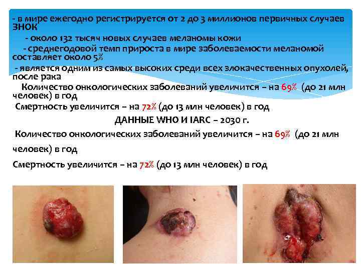 - в мире ежегодно регистрируется от 2 до 3 миллионов первичных случаев ЗНОК -