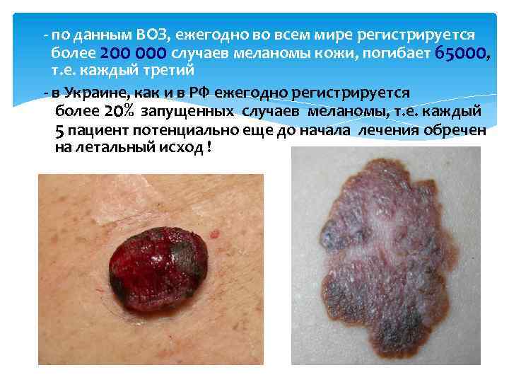 - по данным ВОЗ, ежегодно во всем мире регистрируется более 200 000 случаев меланомы