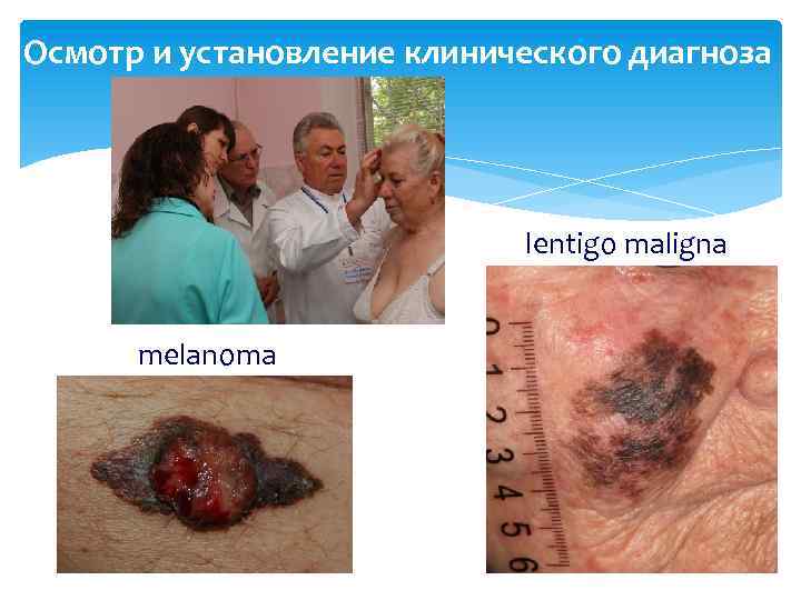 Осмотр и установление клинического диагноза lentigo maligna melanoma 