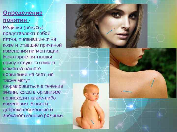 Определение понятия Родинки (невусы) представляют собой пятна, появившиеся на коже и ставшие причиной изменения