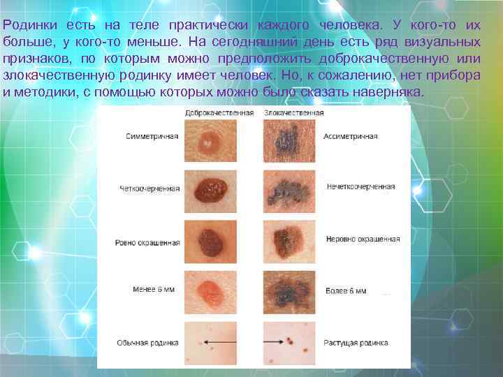 Родинки есть на теле практически каждого человека. У кого-то их больше, у кого-то меньше.