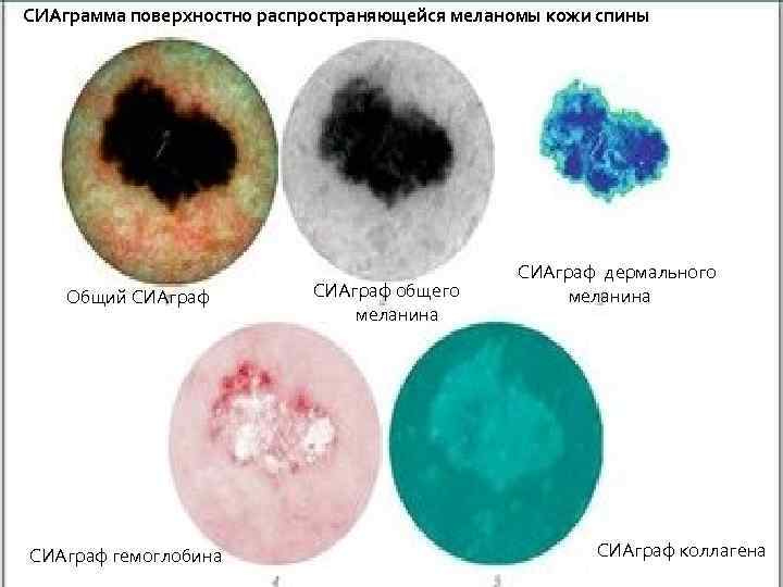 СИАграмма поверхностно распространяющейся меланомы кожи спины Общий СИАграф гемоглобина СИАграф общего меланина СИАграф дермального