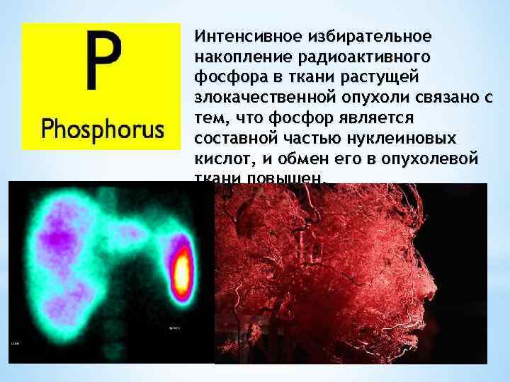 Интенсивное избирательное накопление радиоактивного фосфора в ткани растущей злокачественной опухоли связано с тем, что