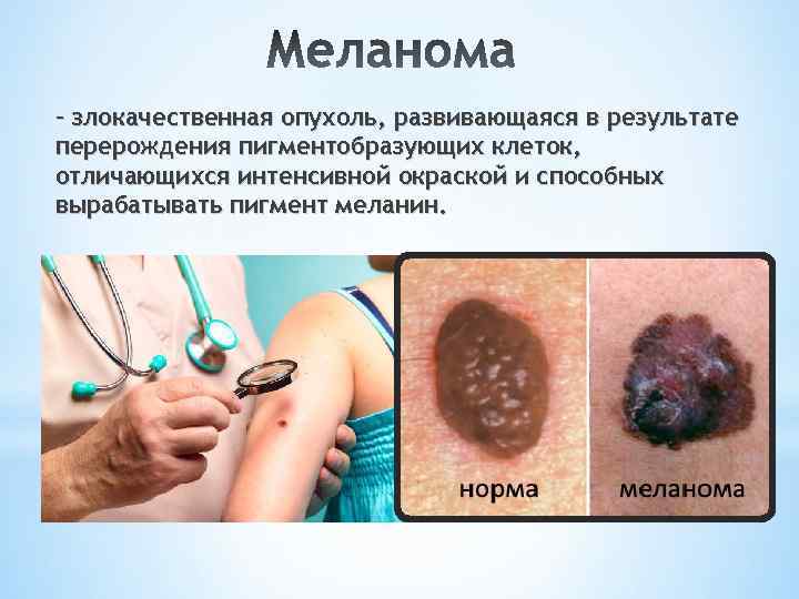 – злокачественная опухоль, развивающаяся в результате перерождения пигментобразующих клеток, отличающихся интенсивной окраской и способных