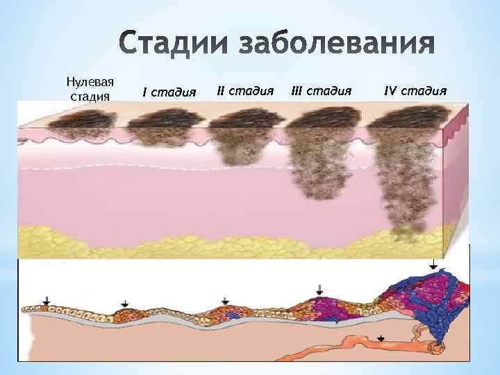 Нулевая стадия III стадия IV стадия 