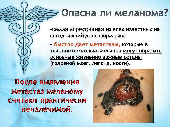 -самая агрессивная из всех известных на сегодняшний день форм рака. - быстро дает метастазы,