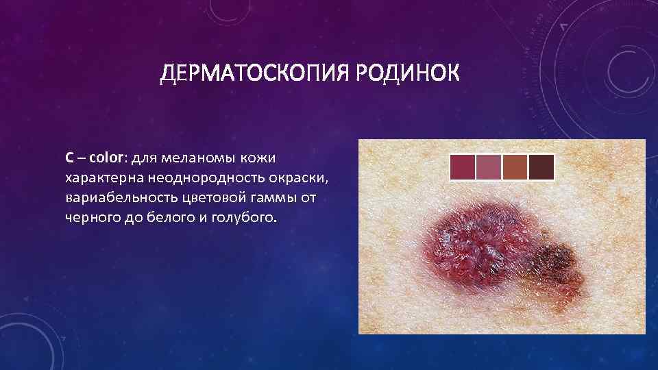ДЕРМАТОСКОПИЯ РОДИНОК С – color: для меланомы кожи характерна неоднородность окраски, вариабельность цветовой гаммы