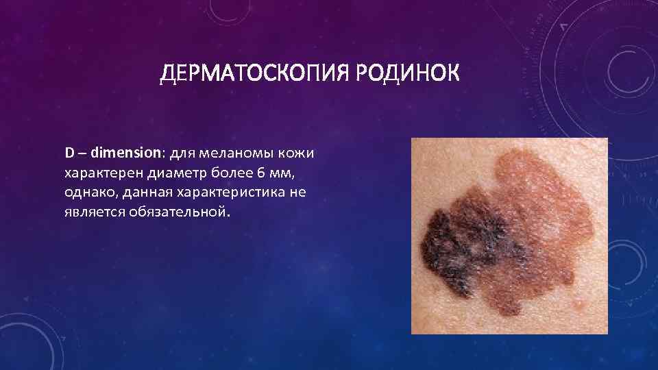 ДЕРМАТОСКОПИЯ РОДИНОК D – dimension: для меланомы кожи характерен диаметр более 6 мм, однако,