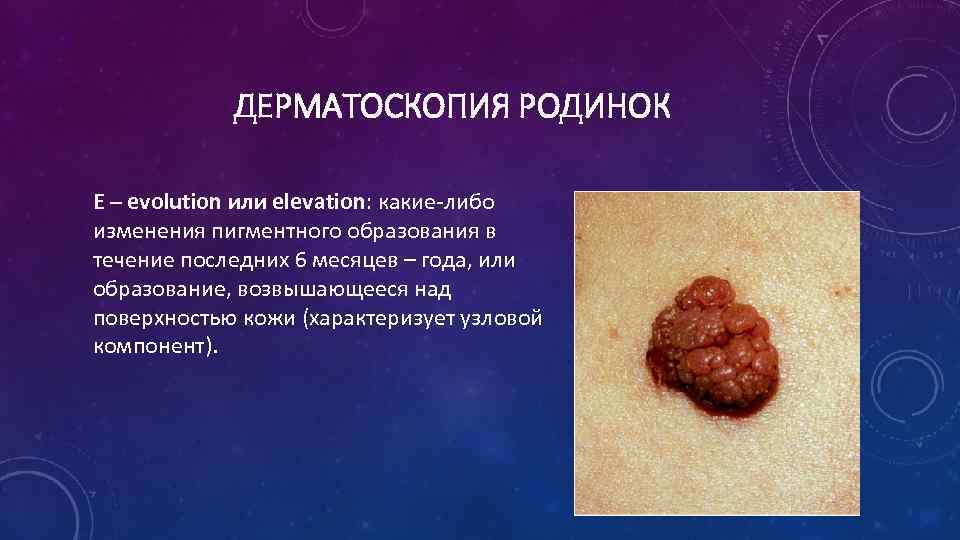 ДЕРМАТОСКОПИЯ РОДИНОК E – evolution или elevation: какие-либо изменения пигментного образования в течение последних