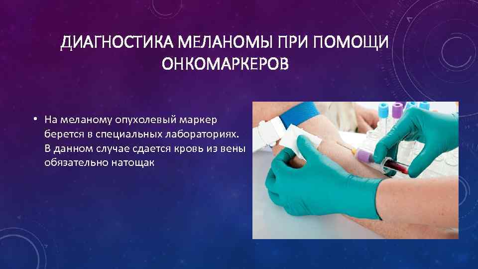 ДИАГНОСТИКА МЕЛАНОМЫ ПРИ ПОМОЩИ ОНКОМАРКЕРОВ • На меланому опухолевый маркер берется в специальных лабораториях.