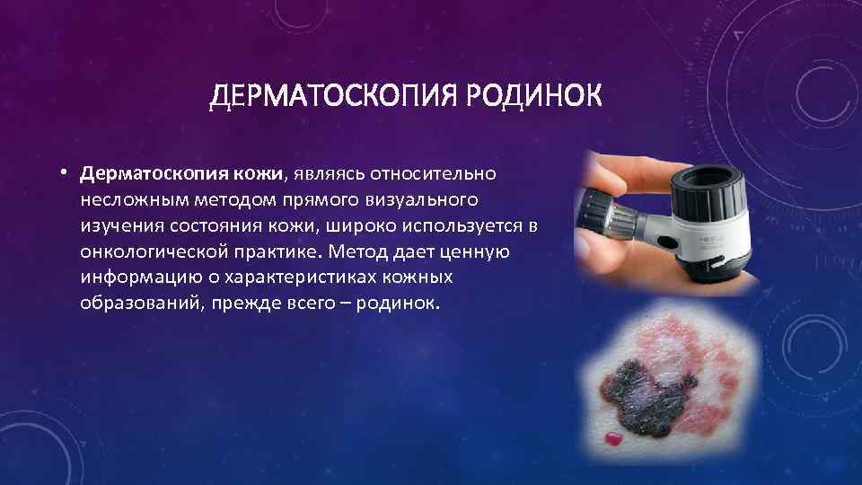ДЕРМАТОСКОПИЯ РОДИНОК • Дерматоскопия кожи, являясь относительно несложным методом прямого визуального изучения состояния кожи,