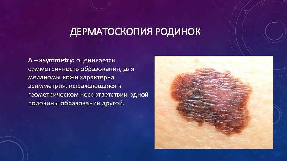 ДЕРМАТОСКОПИЯ РОДИНОК A – asymmetry: оценивается симметричность образования, для меланомы кожи характерна асимметрия, выражающаяся