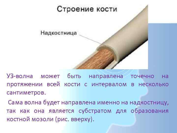 УЗ-волна может быть направлена точечно на протяжении всей кости с интервалом в несколько сантиметров.