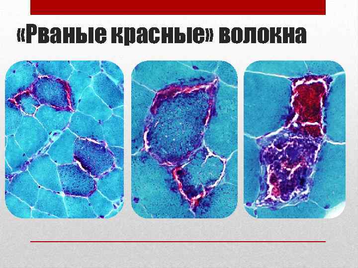  «Рваные красные» волокна 