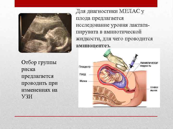 Для диагностики МЕЛАС у плода предлагается исследование уровня лактатапирувата в амниотической жидкости, для чего
