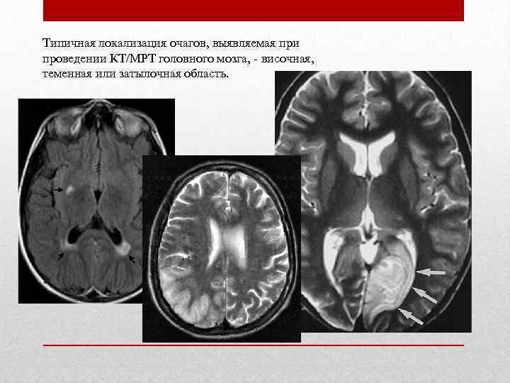 Типичная локализация очагов, выявляемая при проведении КТ/МРТ головного мозга, - височная, теменная или затылочная