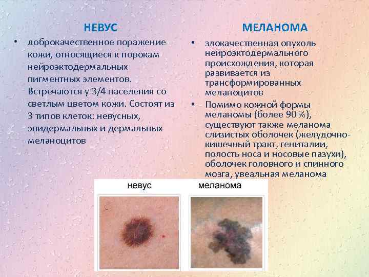 НЕВУС • доброкачественное поражение кожи, относящиеся к порокам нейроэктодермальных пигментных элементов. Встречаются у 3/4