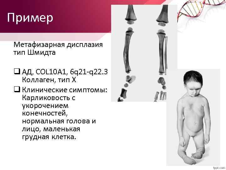Пример Метафизарная дисплазия тип Шмидта q АД, COL 10 A 1, 6 q 21