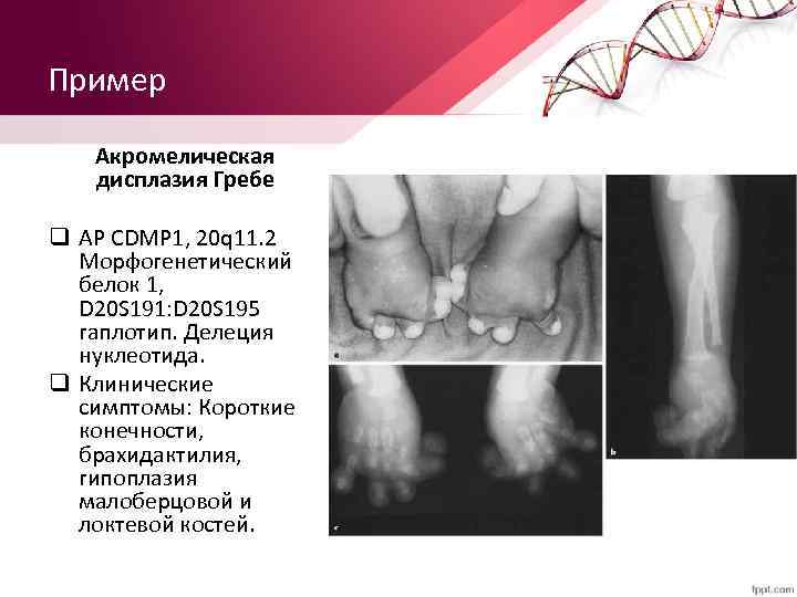 Пример Акромелическая дисплазия Гребе q АР CDMP 1, 20 q 11. 2 Морфогенетический белок