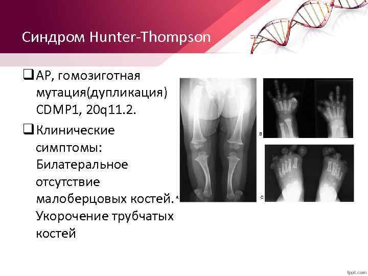 Синдром Hunter-Thompson q АР, гомозиготная мутация(дупликация) CDMP 1, 20 q 11. 2. q Клинические