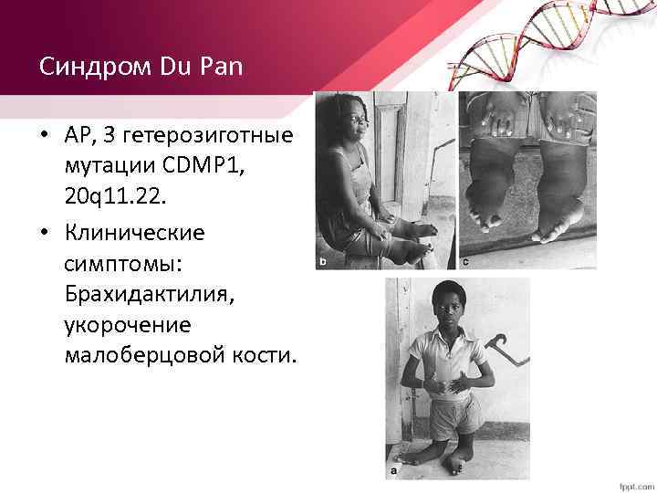 Синдром Du Pan • АР, 3 гетерозиготные мутации CDMP 1, 20 q 11. 22.