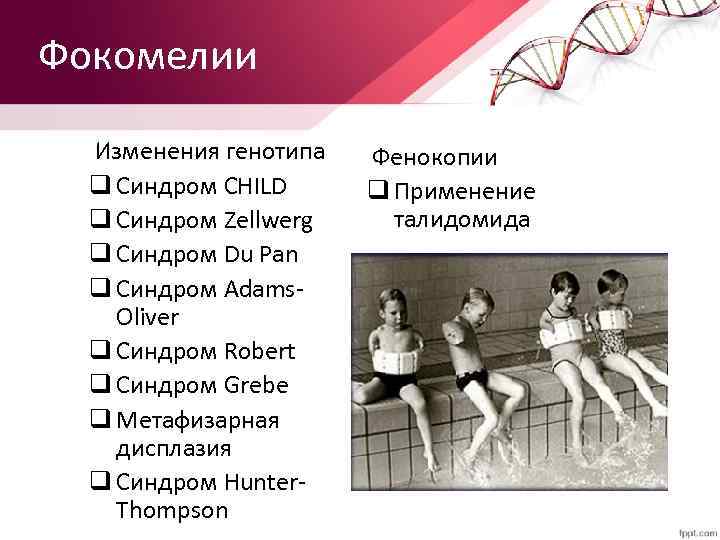 Фокомелии Изменения генотипа q Синдром CHILD q Синдром Zellwerg q Синдром Du Pan q
