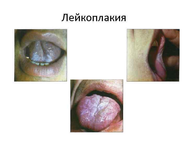 Лейкоплакия 