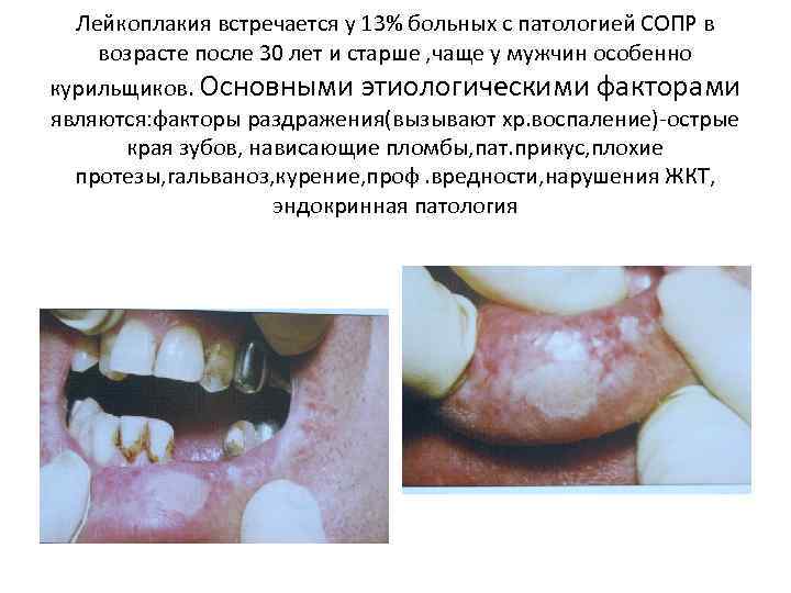 Лейкоплакия встречается у 13% больных с патологией СОПР в возрасте после 30 лет и